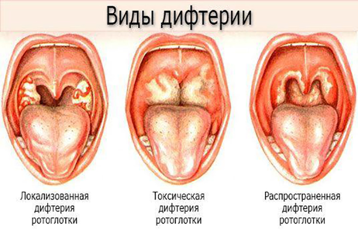 difteriya1