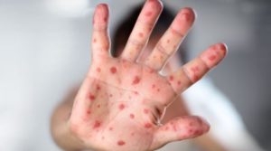 Болеют и взрослые, и дети: в Краматорске количество больных корью увеличилось, работает оперативный штаб