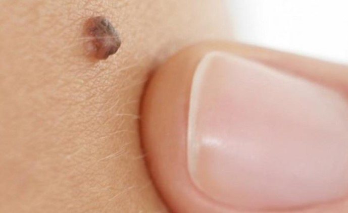 Дерматолог рассказал, какие родинки наиболее опасны