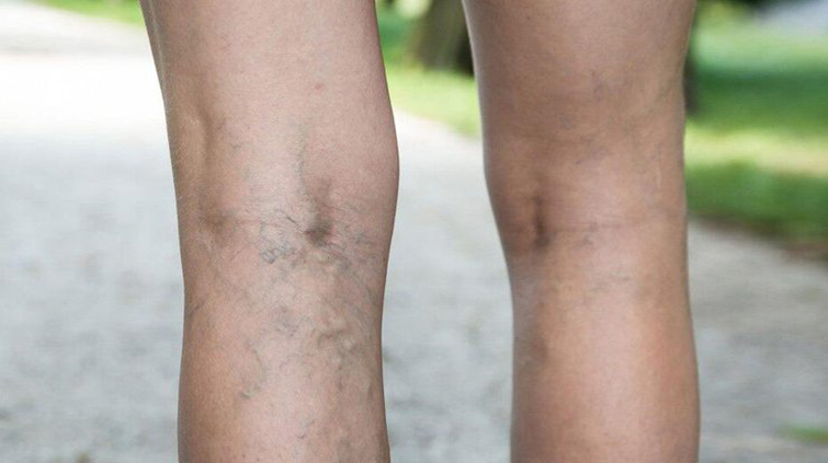 Как избежать варикоза