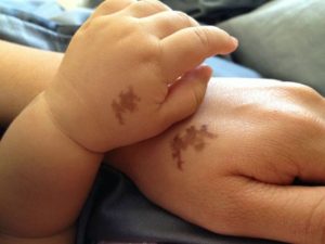 Что означают родимые пятна у мужчин и у женщин