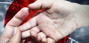 В Украине повысился риск вспышки кори