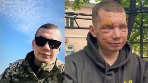 Благодійники зібрали 5 млн грн на лікування мешканця Слов’янська, який на війні втратив зір та слух