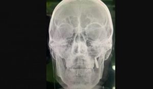 Дивом врятувався: у бійця ЗСУ в зубах застрягла куля