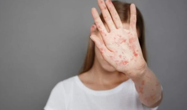 В Україні вже фіксують спалахи кору: як захистити себе та дітей від небезпечної інфекції