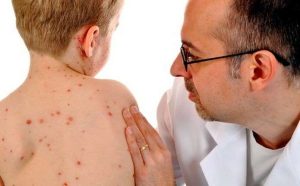 Імовірність спалаху кору зростає: як себе захистити