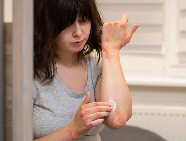 Що можна і не можна робити при опіках шкіри