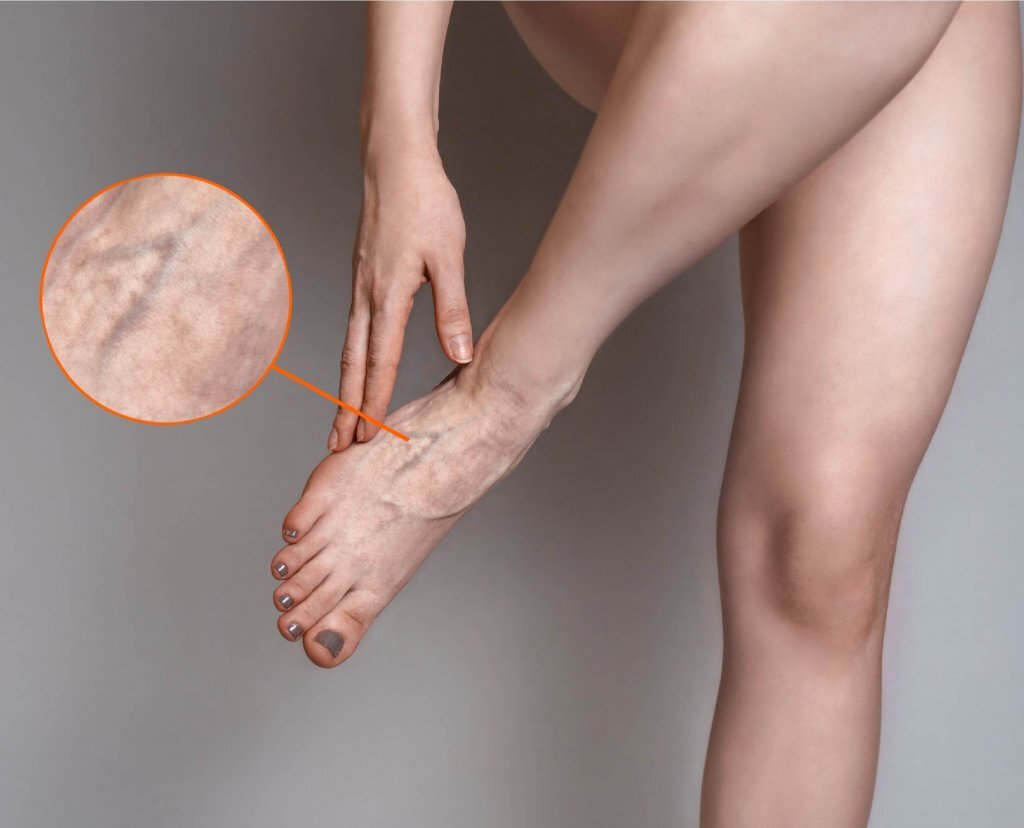 Почему ноги отказываются идти вперед: психосоматика варикоза