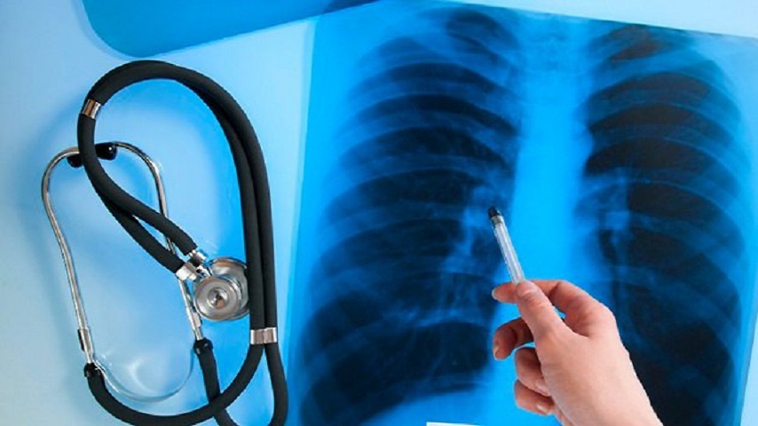 Скільки мешканців Слов’янська захворіли на туберкульоз у 2025 році